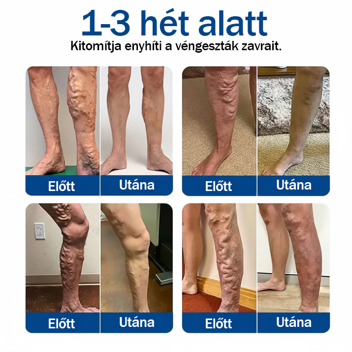 🏆🇭🇺 VeinEase Mikrotűs Tapasz – Azonnali megkönnyebbülés, hosszú távú eredmények a visszerek ellen! ⚡✅