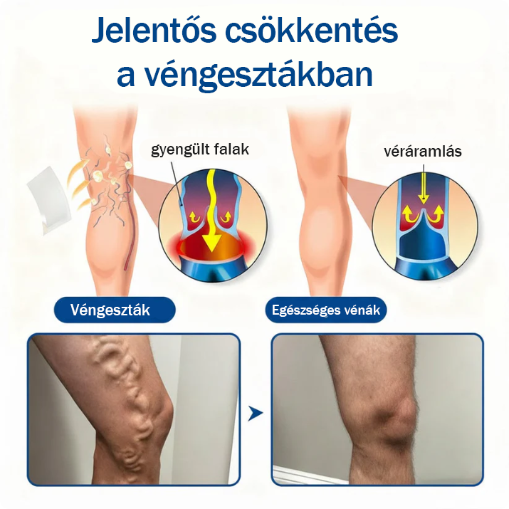 🏆🇭🇺 VeinEase Mikrotűs Tapasz – Azonnali megkönnyebbülés, hosszú távú eredmények a visszerek ellen! ⚡✅
