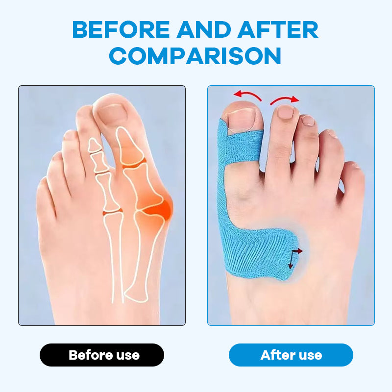 👣 Előre kivágott hallux valgus korrekciós kineziológiai tapasz – fájdalom nélküli lépések, természetes tartás