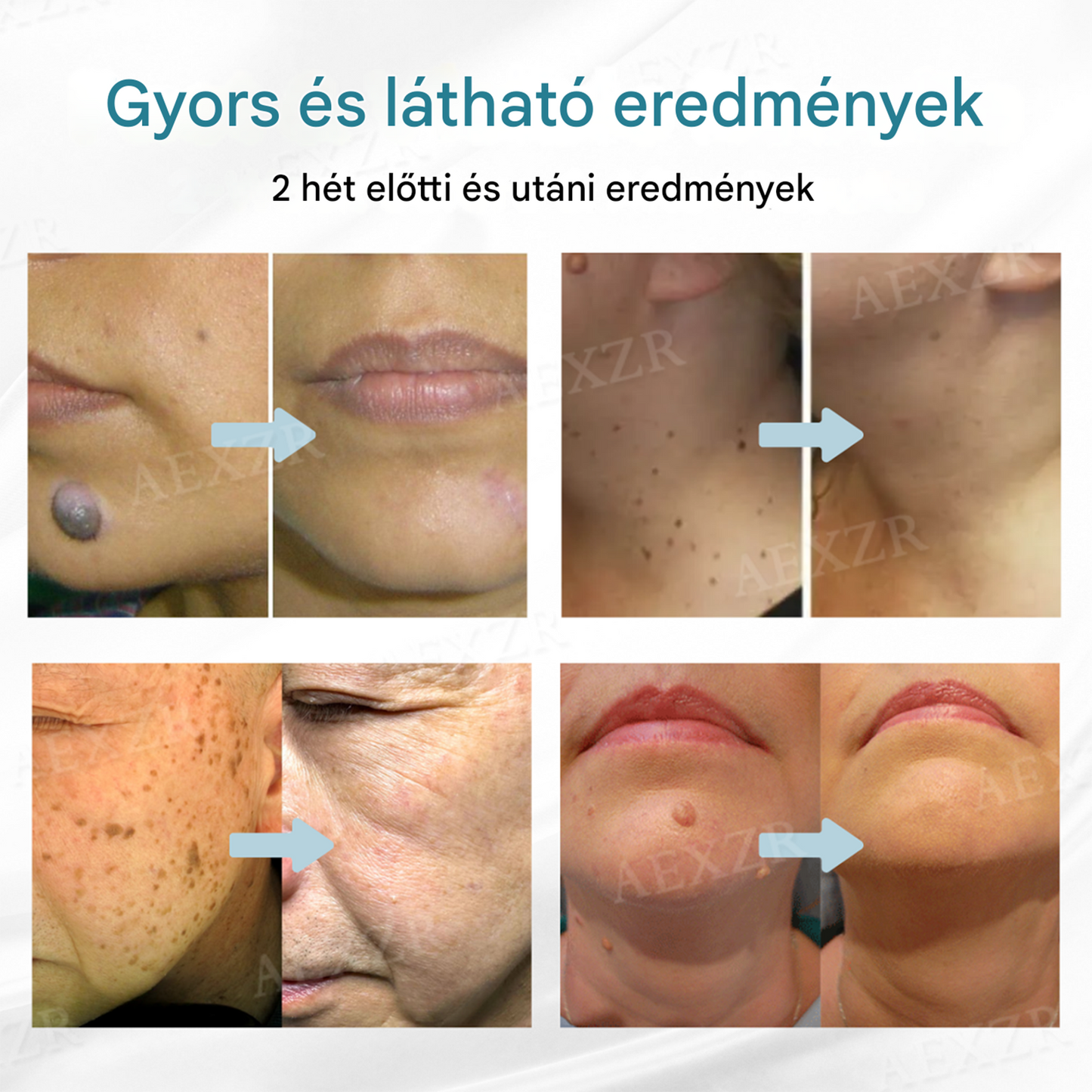 Bikenda® non-invazív anyajegy- és szemölcseltávolító lézertoll