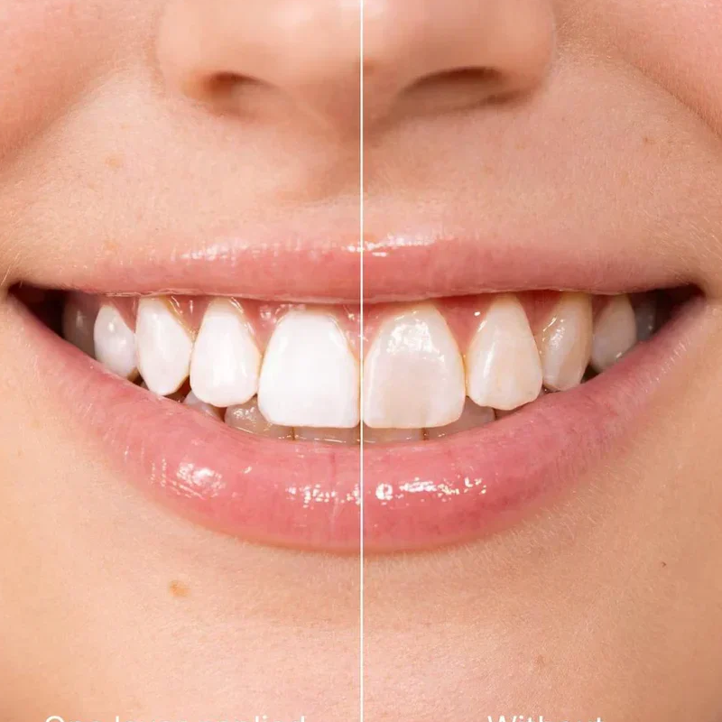 ✨ Azonnali fogfehérítő fogkrém — Az eredmények azonnal láthatóak! 5 ml-es kiszerelés, hosszú élettartam! 😁🦷